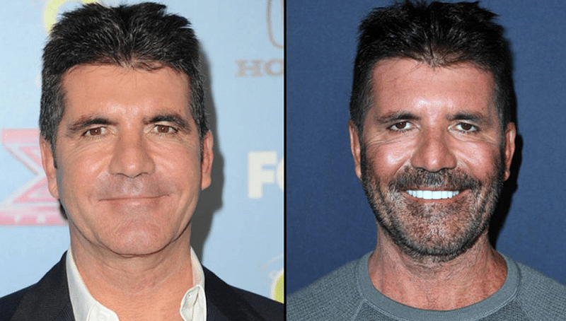 Simon Cowell Plastic Surgery